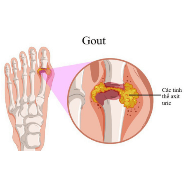 Benh Gout Co Nguy Hiem Khong ..