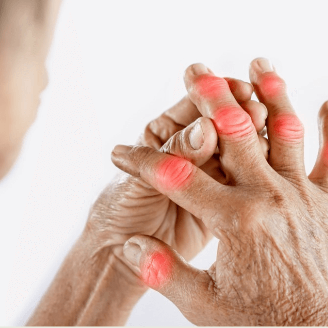 Benh Gout Co Nguy Hiem Khong .