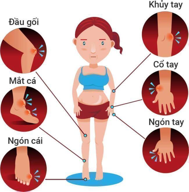Bệnh Gout có nguy hiểm không