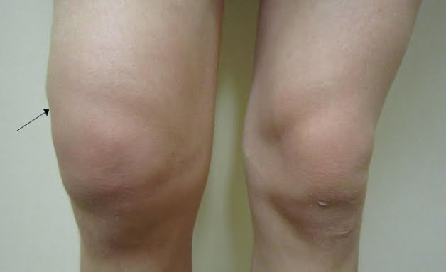 điều trị ᴠiêm khớр gối tràn dịch, ᴠiêm khớр gối