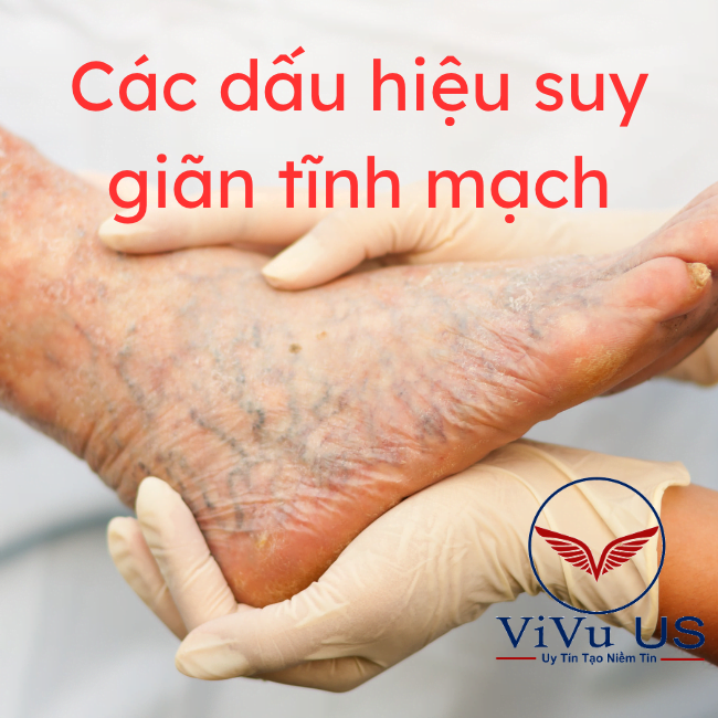 Các dấu hiệu suy giãn tĩnh mạch